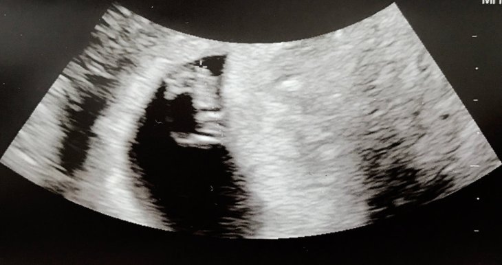 we called him croissant baby haha! little did we know his arm rolls would look very familiar!